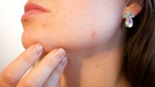 4 Dicas para quem tem acne